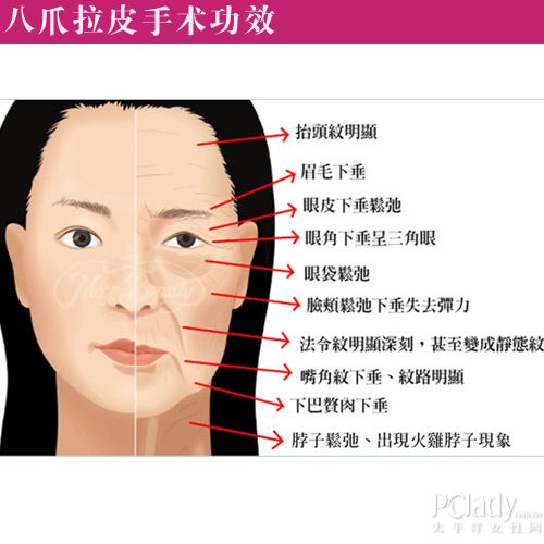 最新拉皮术，重塑肌肤年轻态的革命性技术